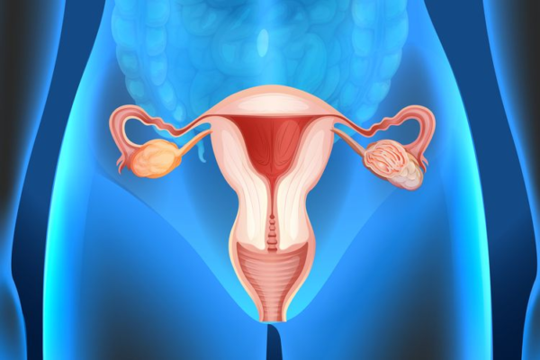 Simak Ciri Ciri Kista Ovarium Dan Penanganannya Berikut Ini Sebelum